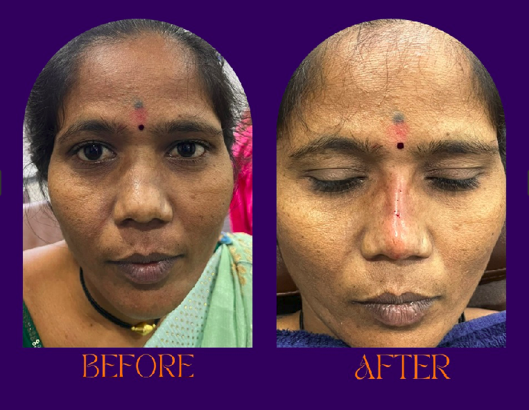Skin rejuvenation before and after