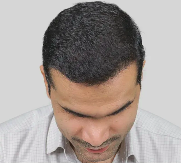 After hair restoration treatment