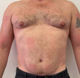 After non-surgical body contouring